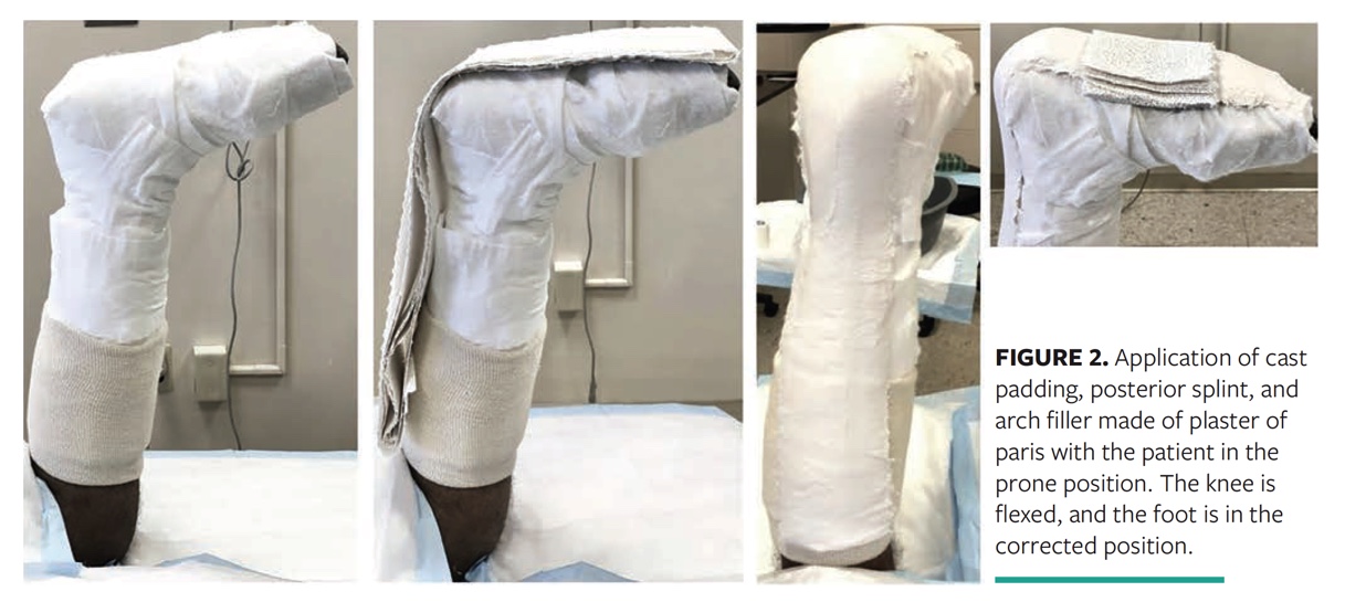 The Custom Total Contact Cast to Offload Foot Ulcers in the Presence of